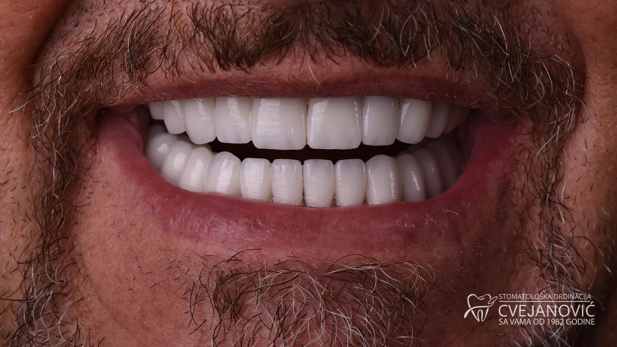 Hollywood smile — fotografija posle terapije