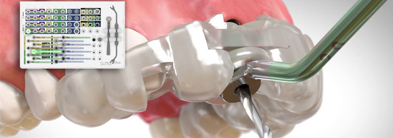 implant izgled