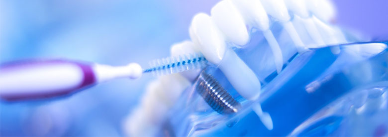 implant izgled