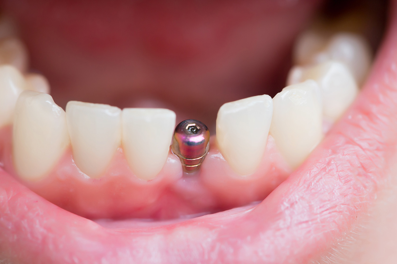 implant izgled