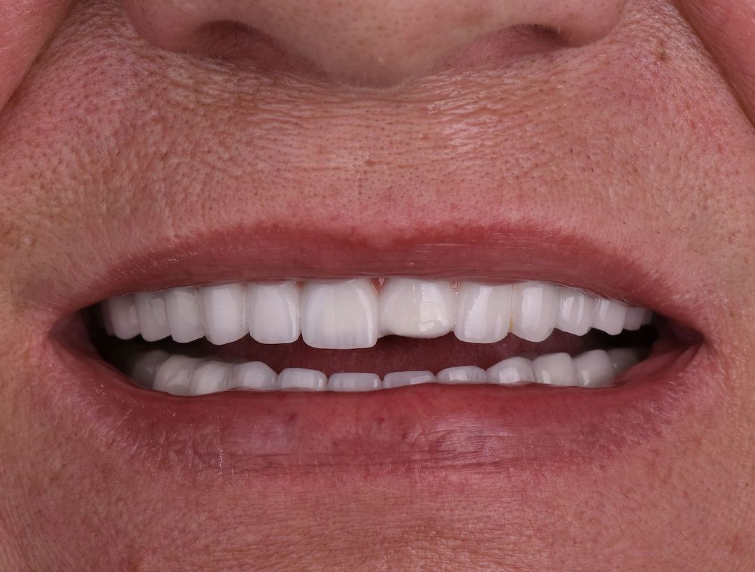 Komplikacije hollywood smile rada — ordinacija Cvejanović