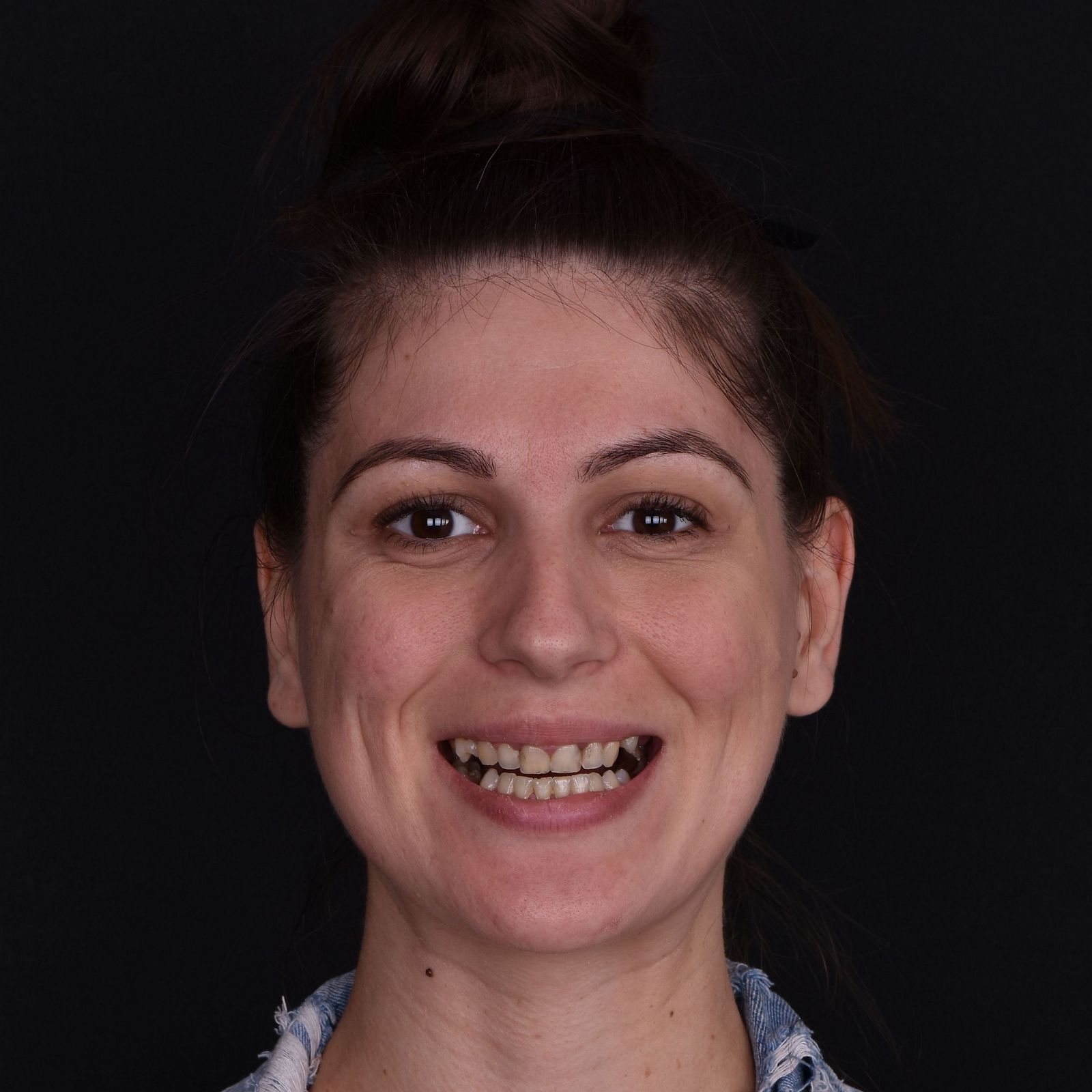 zubne krunice