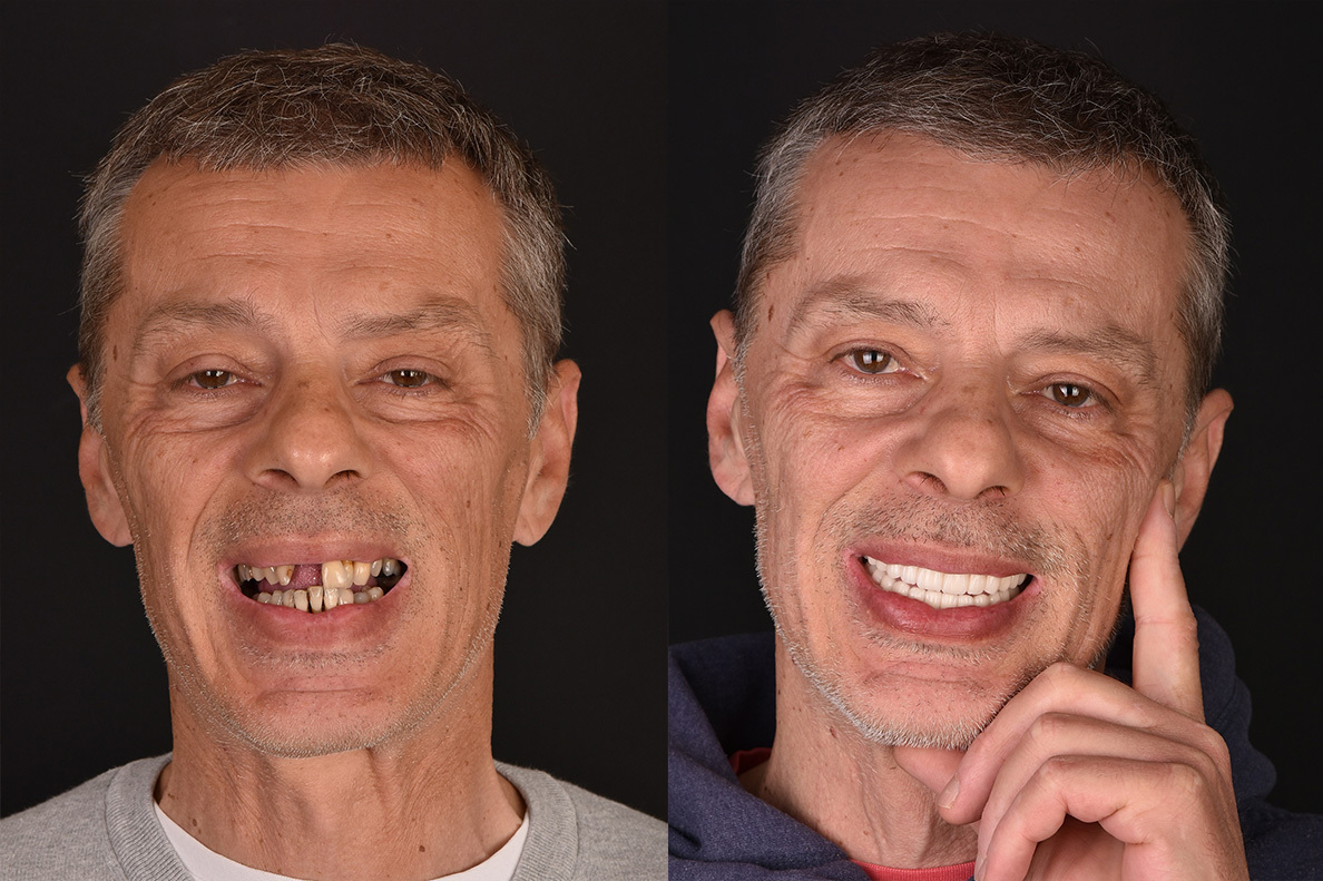 Pre i posle Hollywood smile zahvata