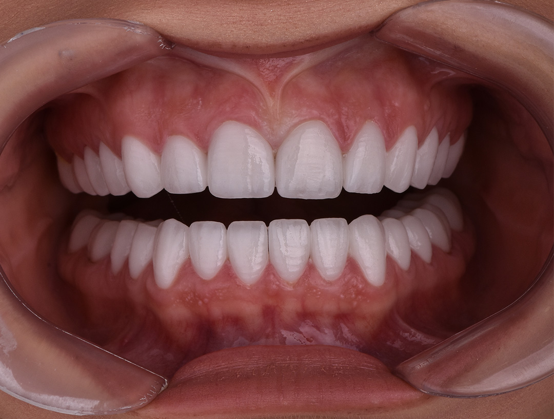 Komplikacije hollywood smile rada — ordinacija Cvejanović