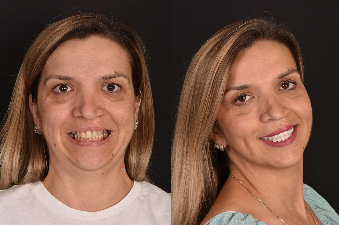 Pre i posle Hollywood smile zahvata
