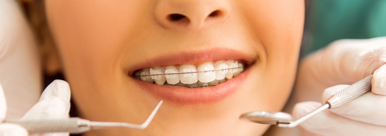holliwood smile