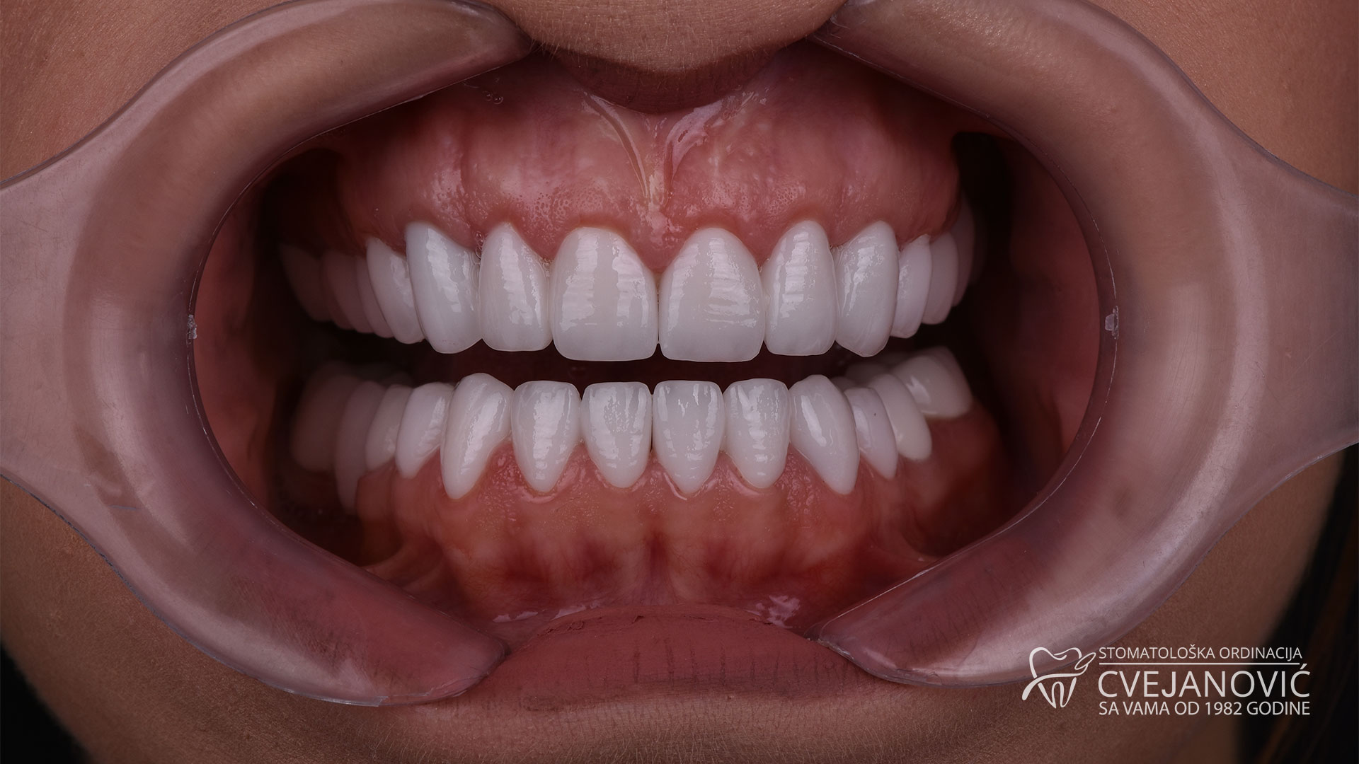 implant izgled