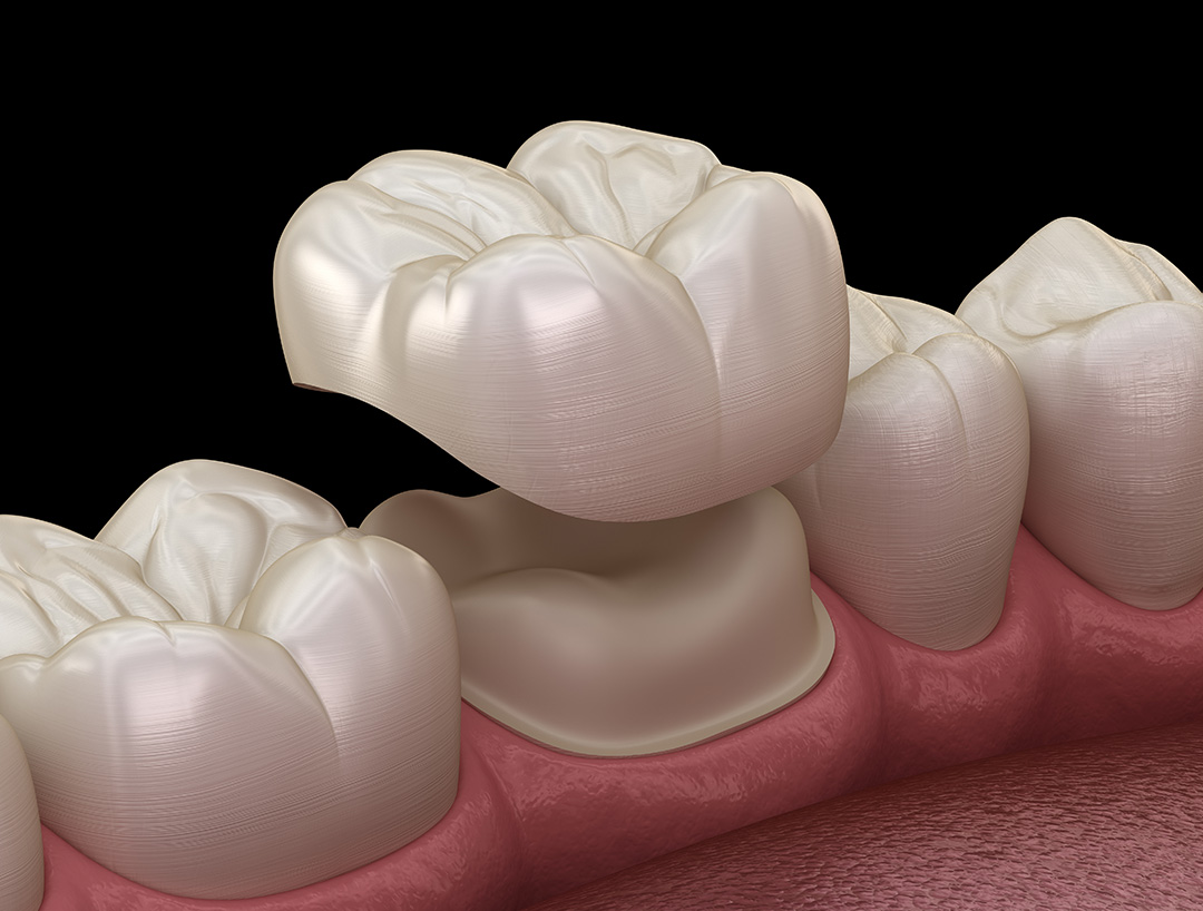 Komplikacije hollywood smile rada — ordinacija Cvejanović