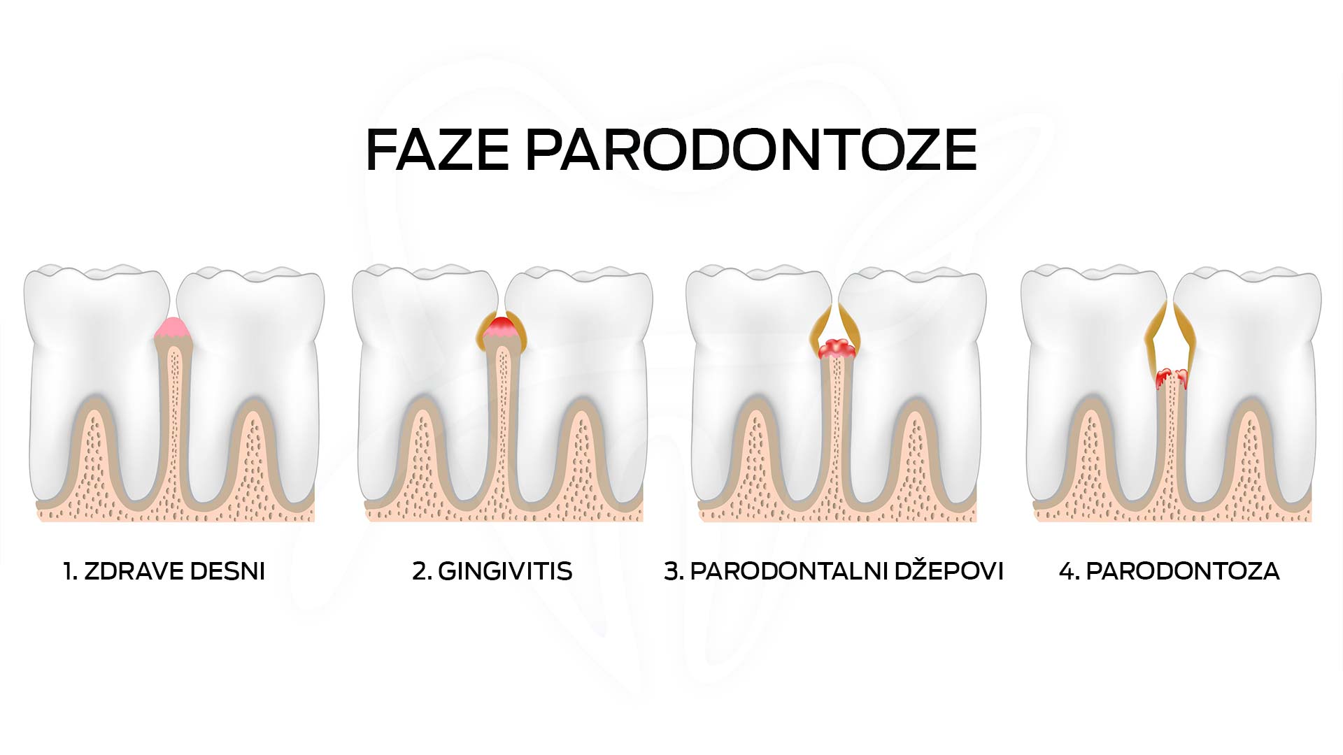 Parodontoza – Parodontopatija — ordinacija Cvejanović