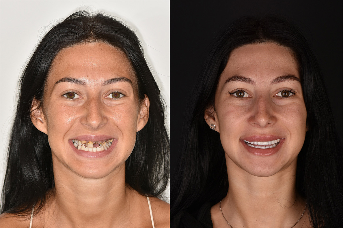 Pre i posle Hollywood smile zahvata