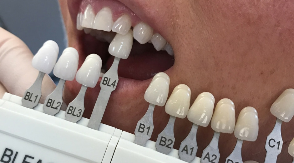 implant izgled